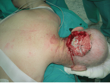 large basal cell carcinoma